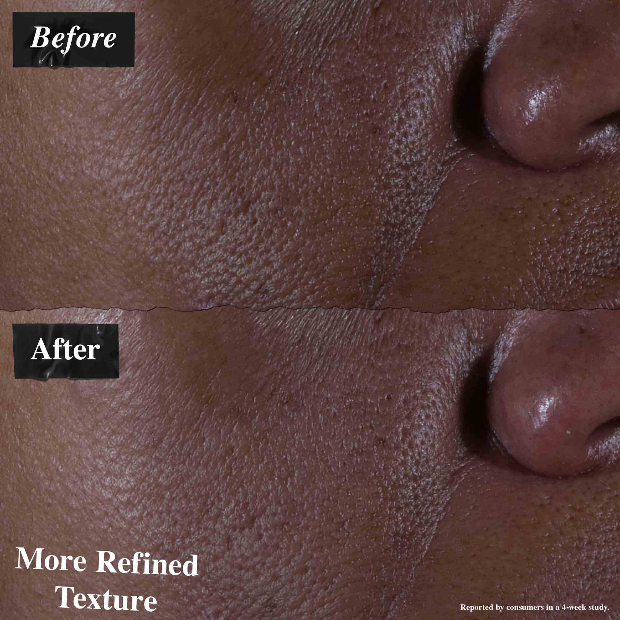 Una comparacion de antes y despues que muestra la piel tratada con Ultra Pure 9.8% Glycolic Acid Serum. La imagen del "antes" muestra una textura desigual, mientras que la imagen del "despues" muestra una textura mas refinada.