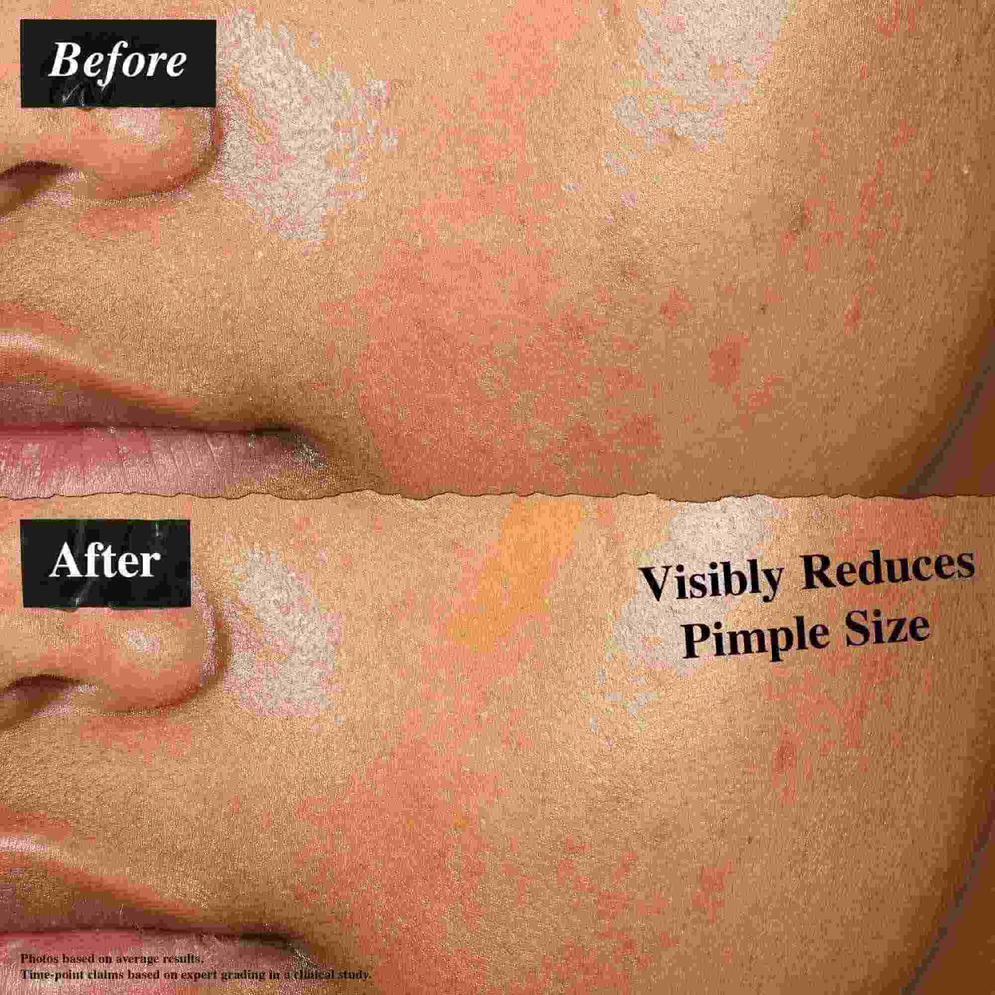 Una comparacion de antes y despues que muestra la piel tratada con Truly-Targeted Blemish-Clearing Solution. La imagen del "antes" muestra granos visibles, mientras que la del "despues" muestra una reduccion en el tamano de los granos.