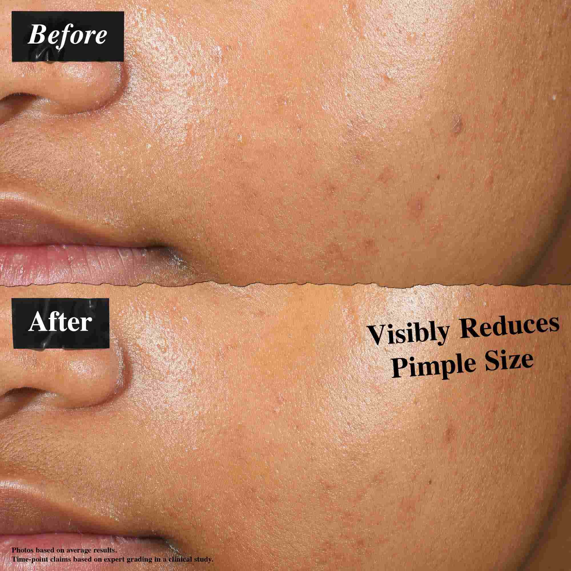 Una comparacion de antes y despues que muestra la piel tratada con Truly-Targeted Blemish-Clearing Solution. La imagen del "antes" muestra granos visibles, mientras que la del "despues" muestra una reduccion en el tamano de los granos.