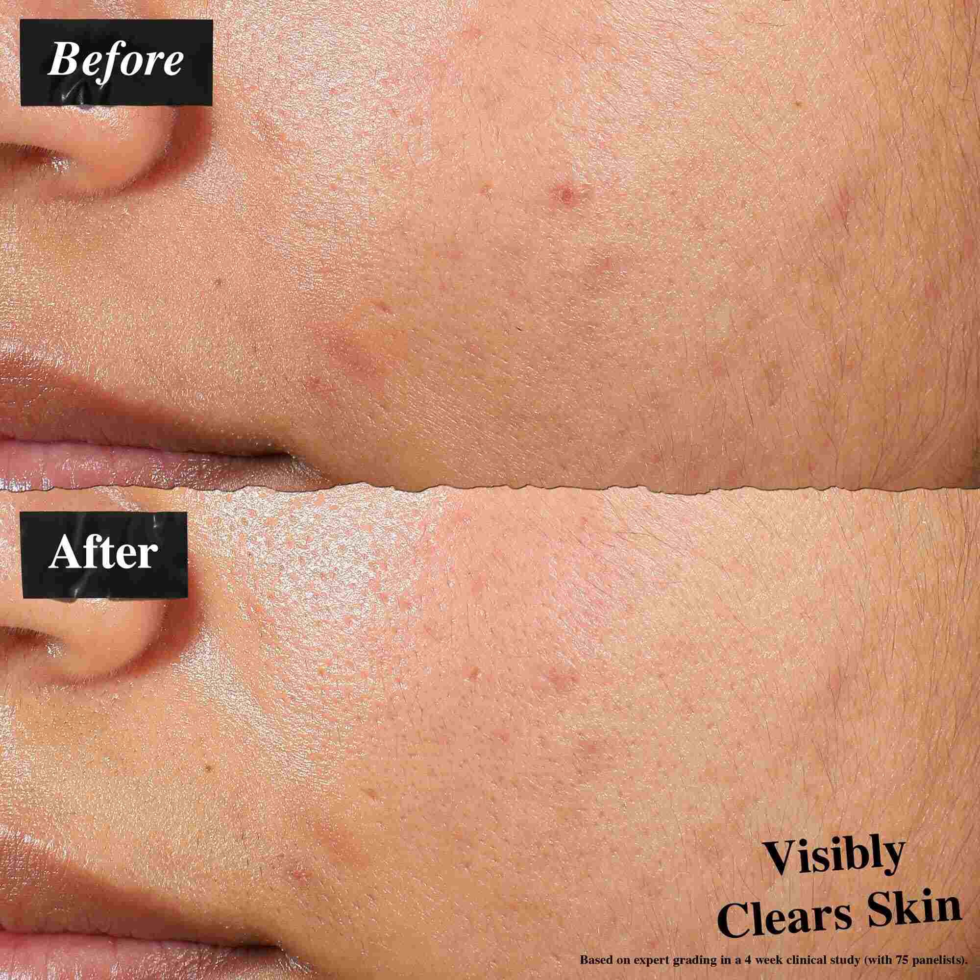 Una comparacion de antes y despues que muestra la piel tratada con Expertly Clear Blemish-Treating & Preventing Lotion. La imagen del "antes" muestra imperfecciones y textura desigual, mientras que la imagen del "despues" muestra una piel visiblemente mas clara.