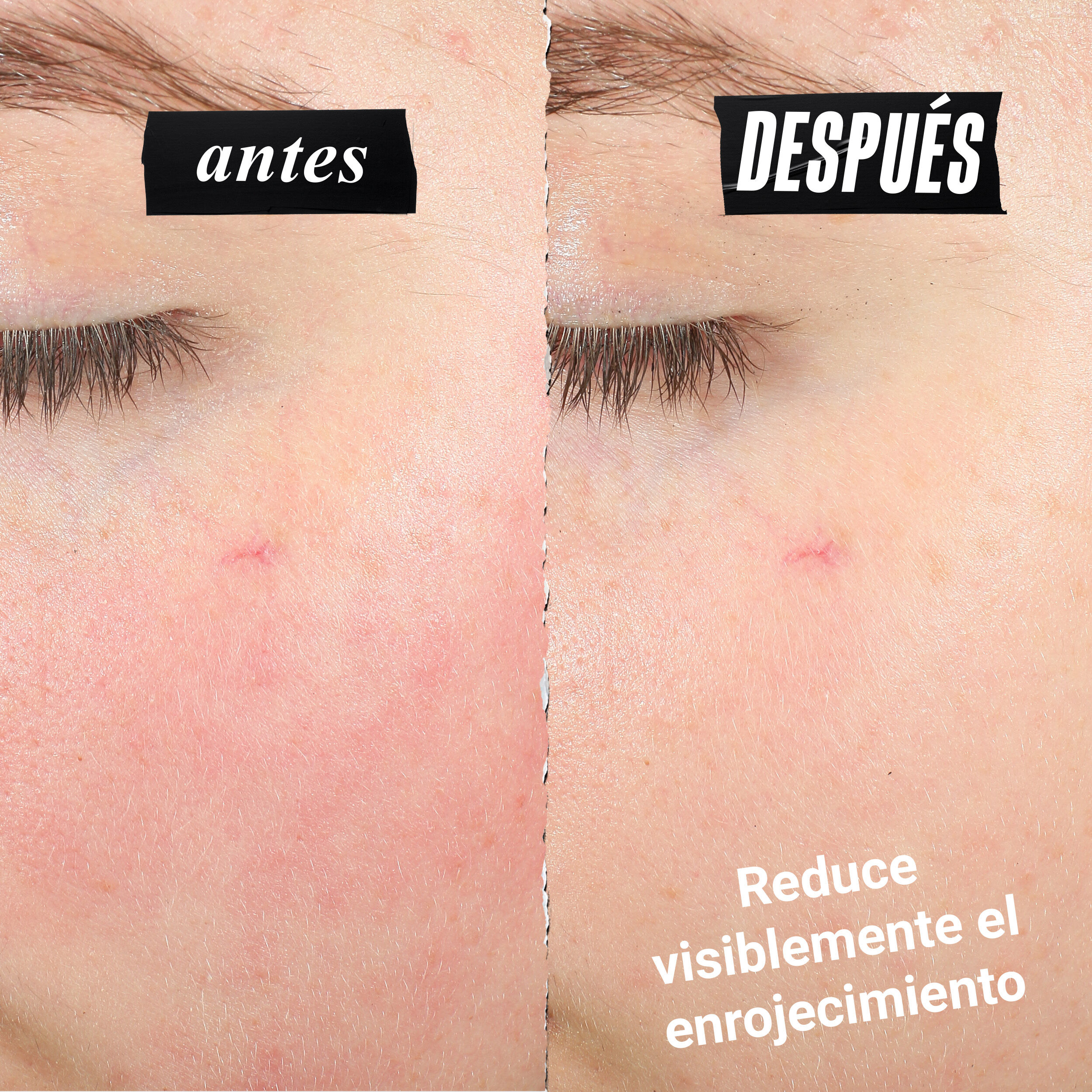 Comparacion que muestra la reduccion del enrojecimiento en la piel. El texto dice: Reduce visiblemente el enrojecimiento.