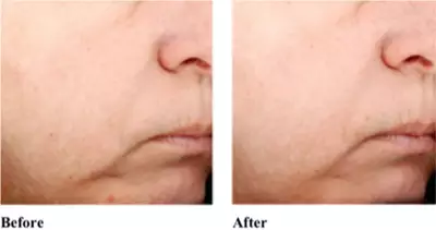 Before and after